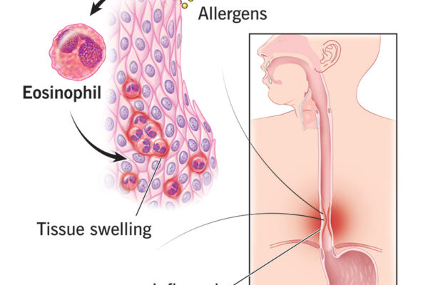 How I Cured My Eosinophilic Esophagitis: A Personal Journey How I Cured My Eosinophilic Esophagitis