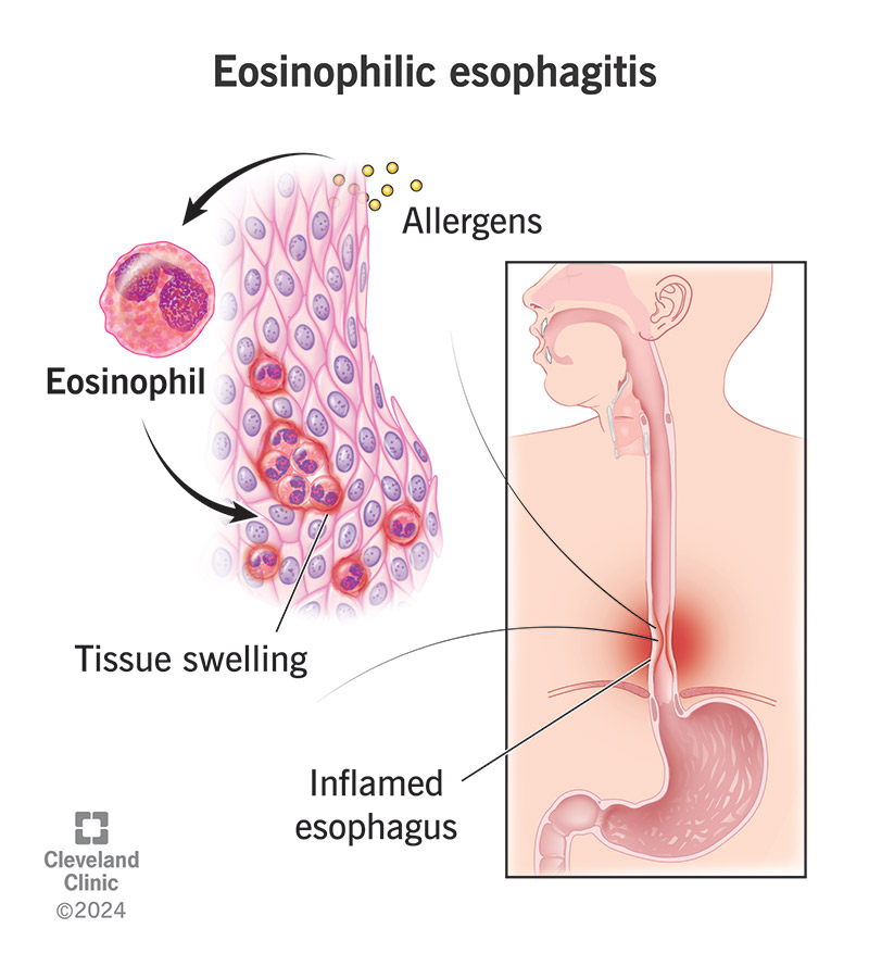 How I Cured My Eosinophilic Esophagitis