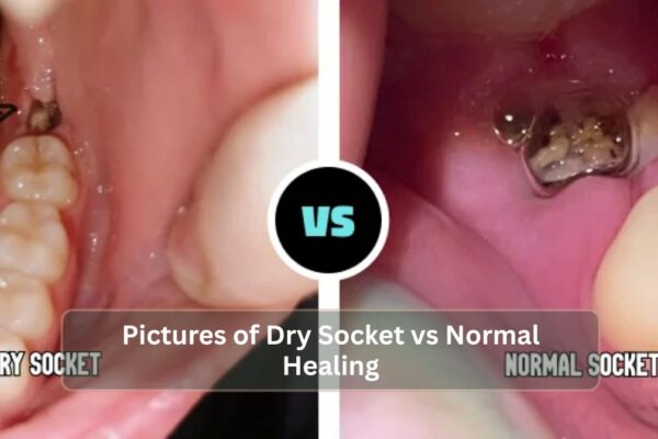 Pictures of Dry Socket vs Normal Healing Pictures of Dry Socket vs Normal Healing