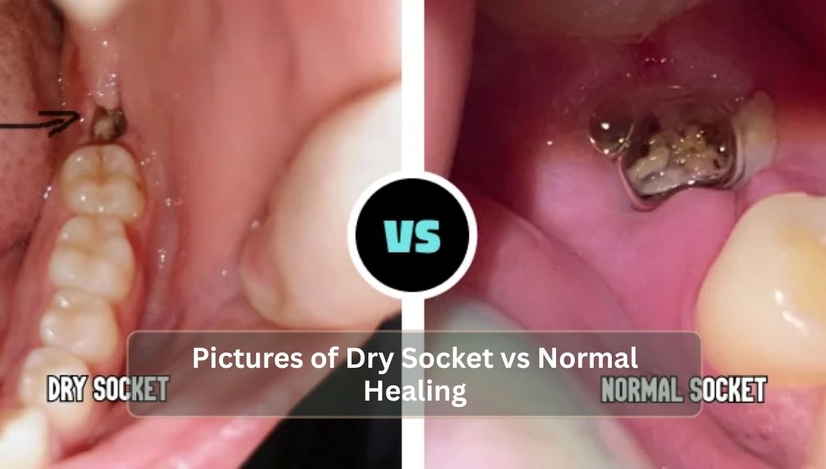Pictures of Dry Socket vs Normal Healing