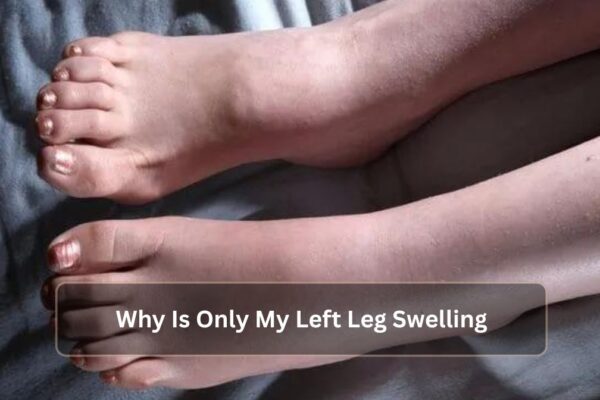 Why Is Only My Left Leg Swelling? Why Is Only My Left Leg Swelling