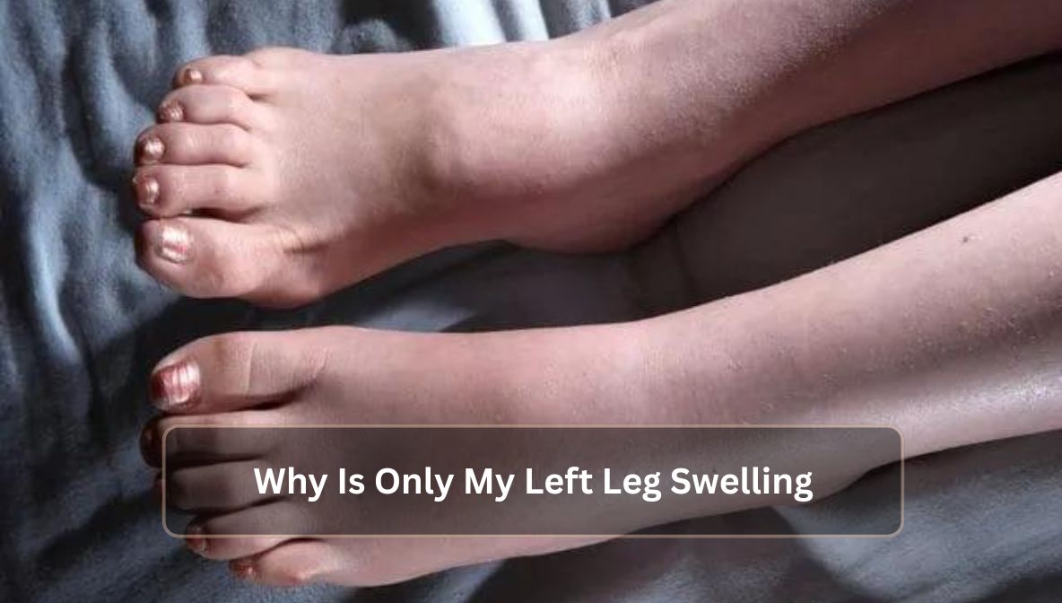 Why Is Only My Left Leg Swelling