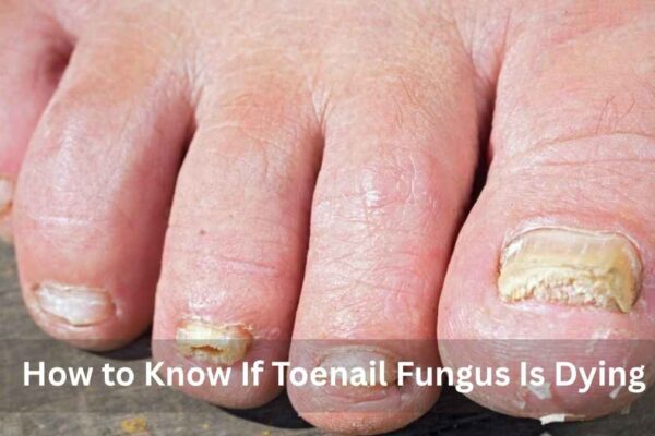 how to know if toenail fungus is dying